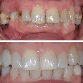 before and after photos of teeth